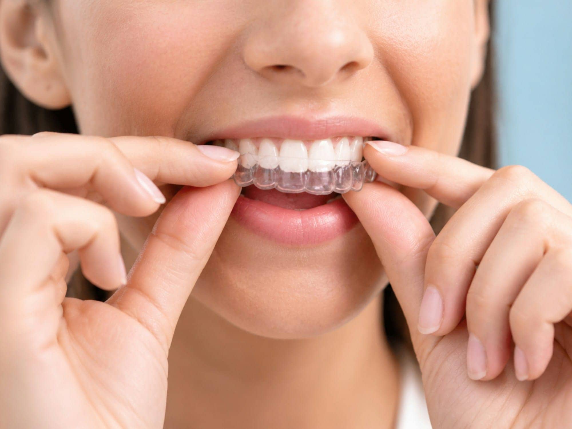 Mise en place d’un aligneur transparent sur les dents