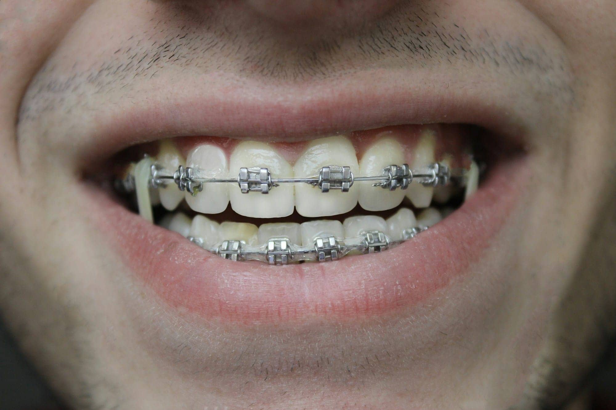 Sourire avec un appareil orthodontique fixe